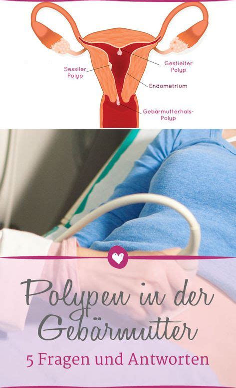 polypen scheideneingang symptome|gebärmutter polypen schmerzen.